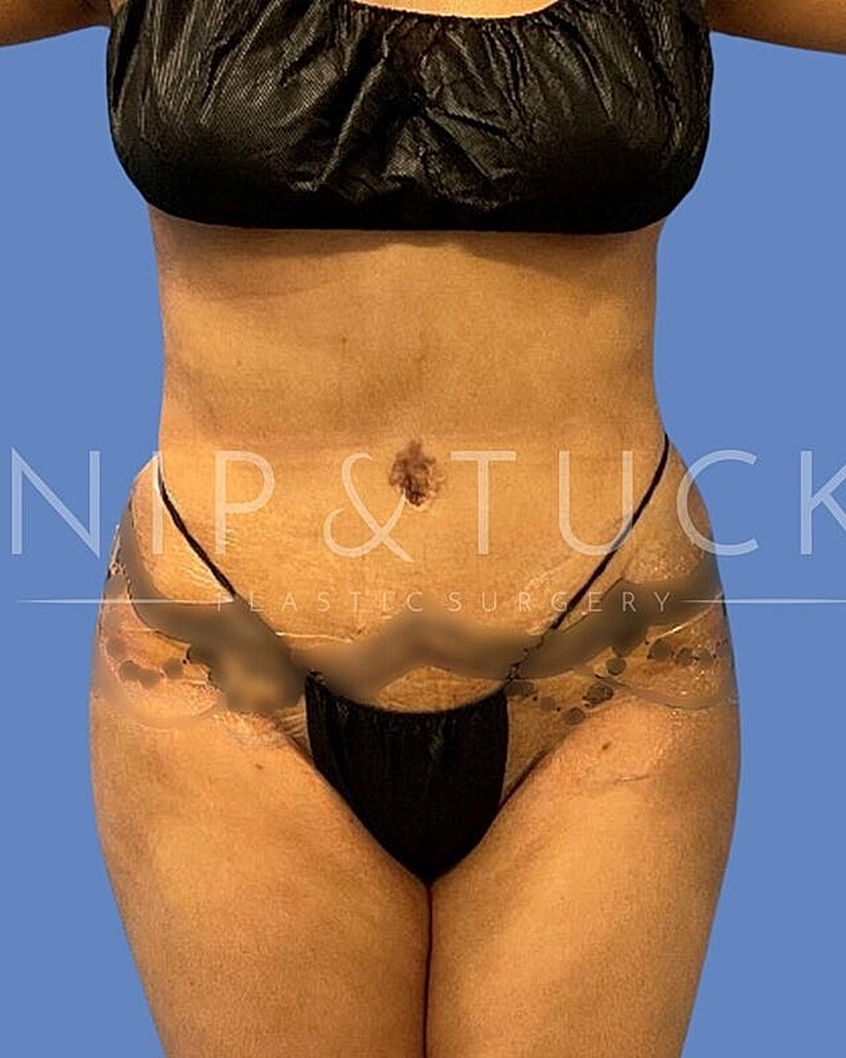 Liposuction Before & After