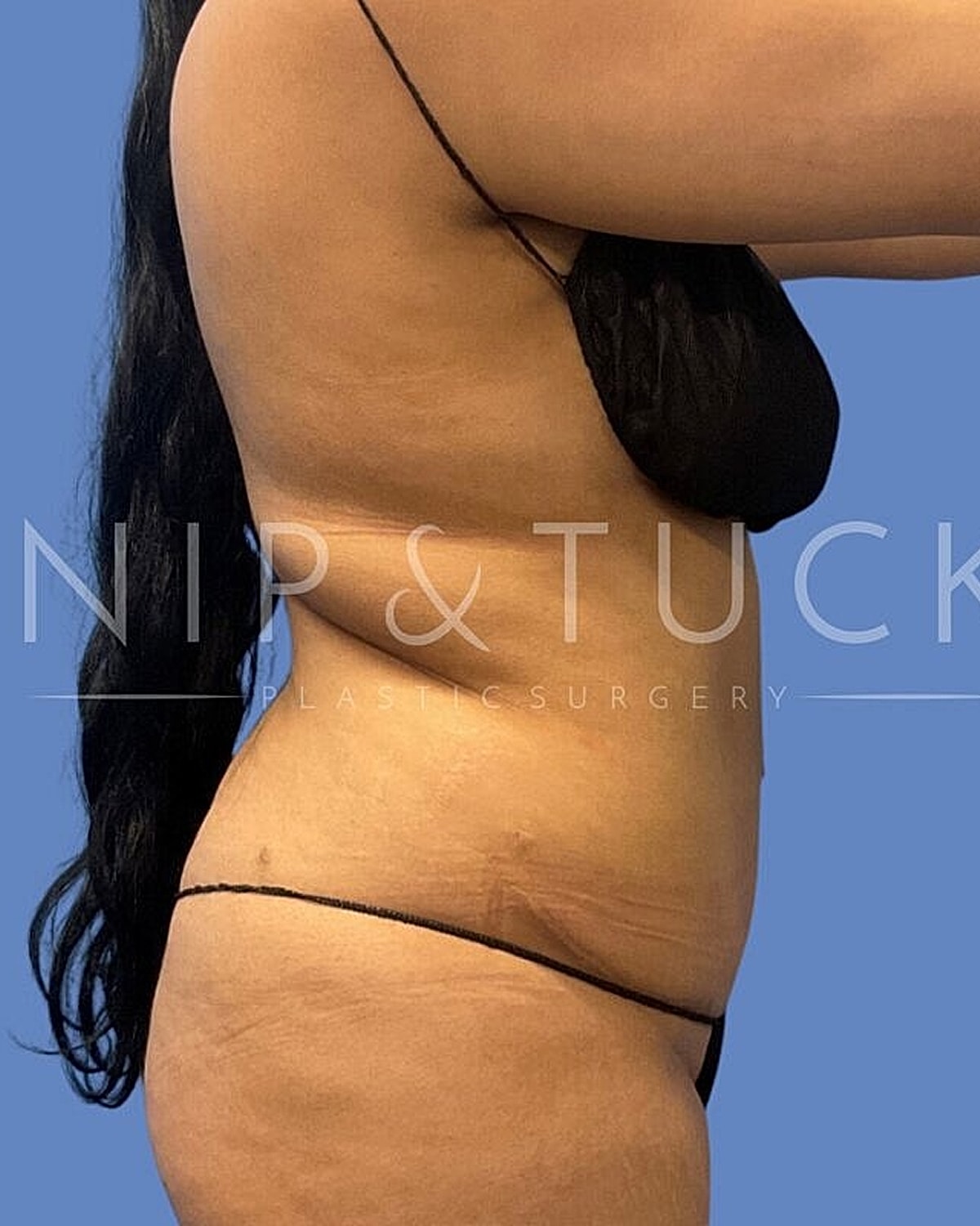 Liposuction Before & After