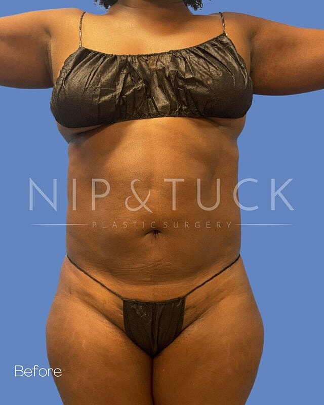 Liposuction Before & After
