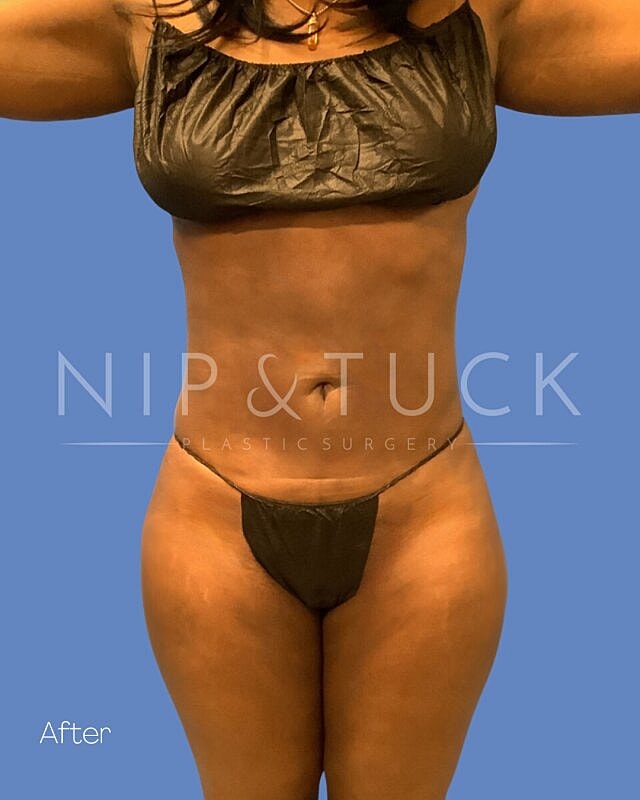 Liposuction Before & After