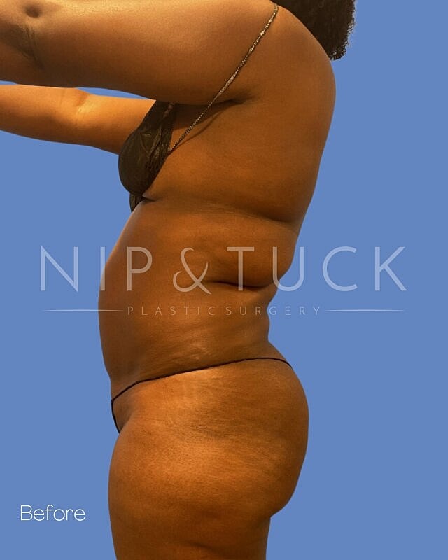 Liposuction Before & After