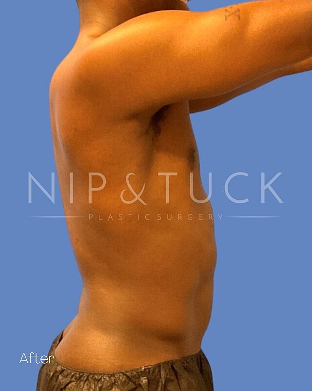 Liposuction Before & After