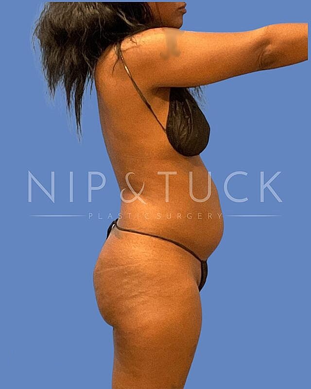 Liposuction Before & After