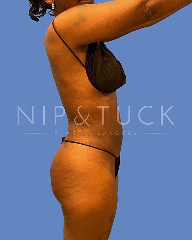 Liposuction Before & After