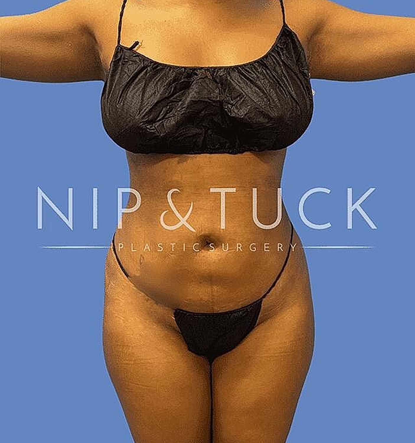 Liposuction Before & After