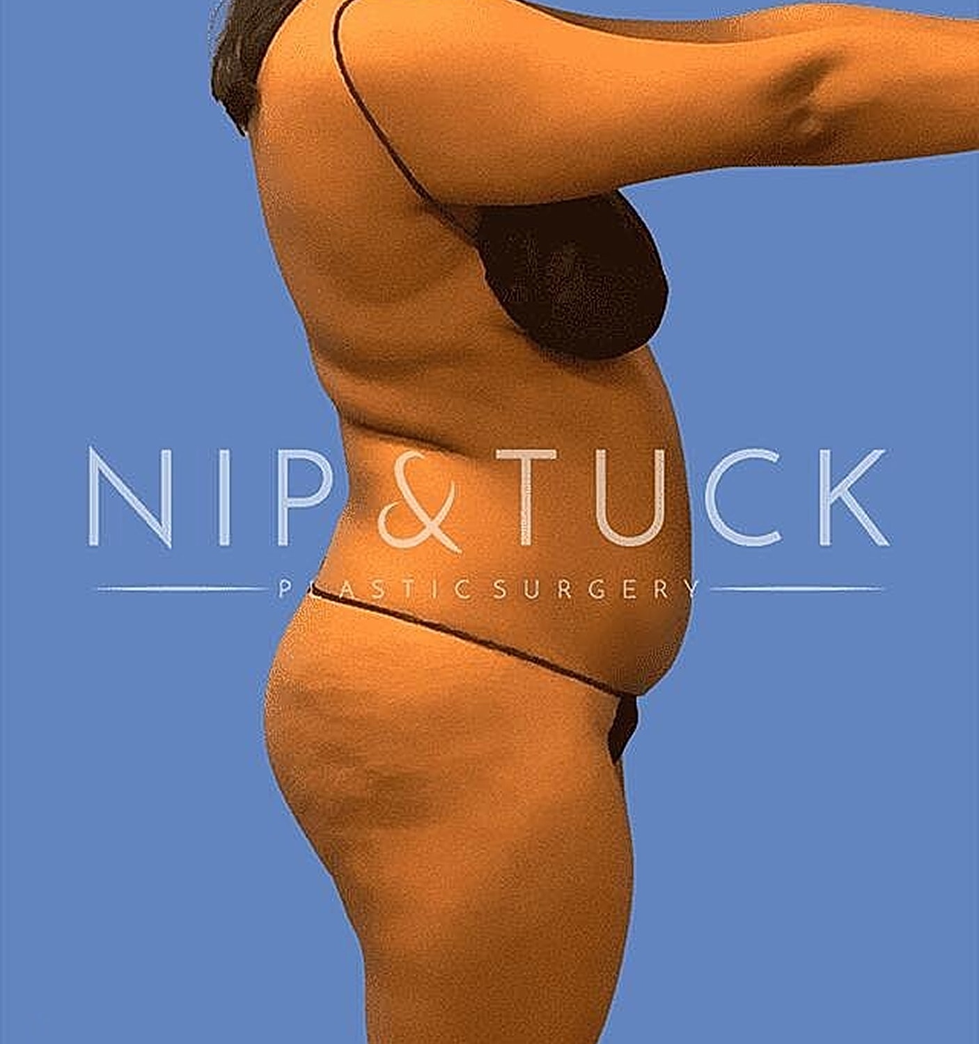 Liposuction Before & After