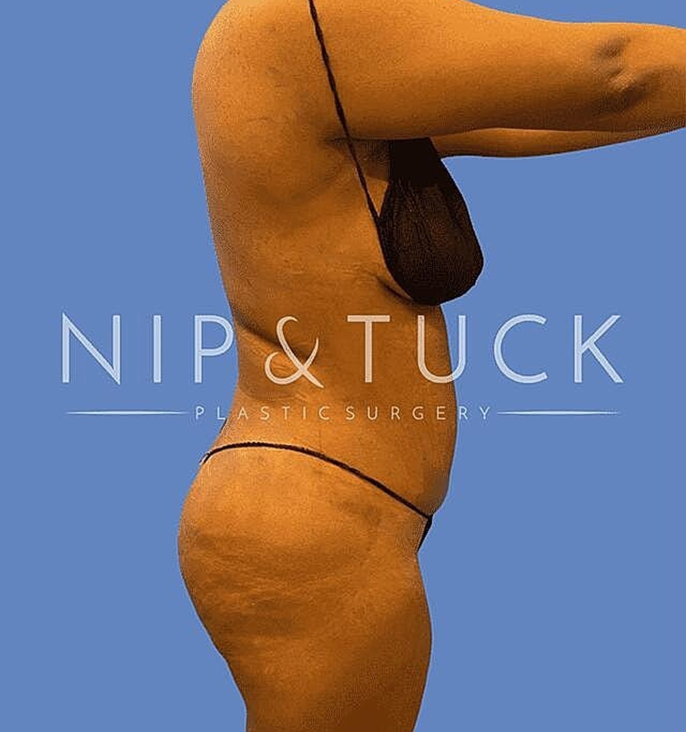 Liposuction Before & After