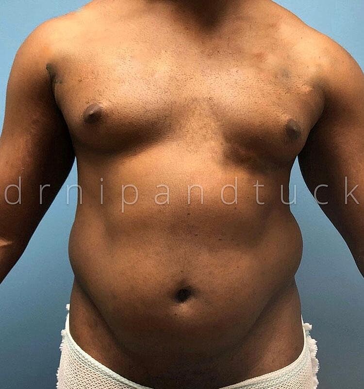 Liposuction Before & After