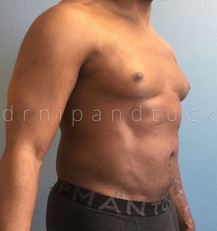 Liposuction Before & After