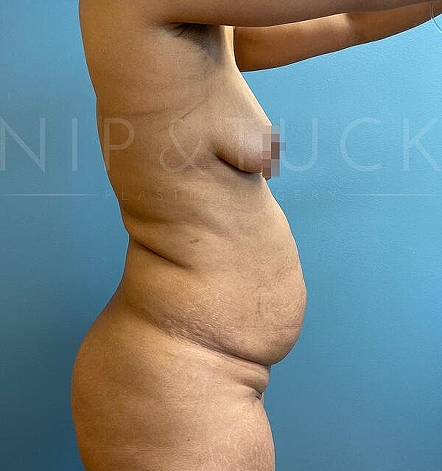 Liposuction Before & After