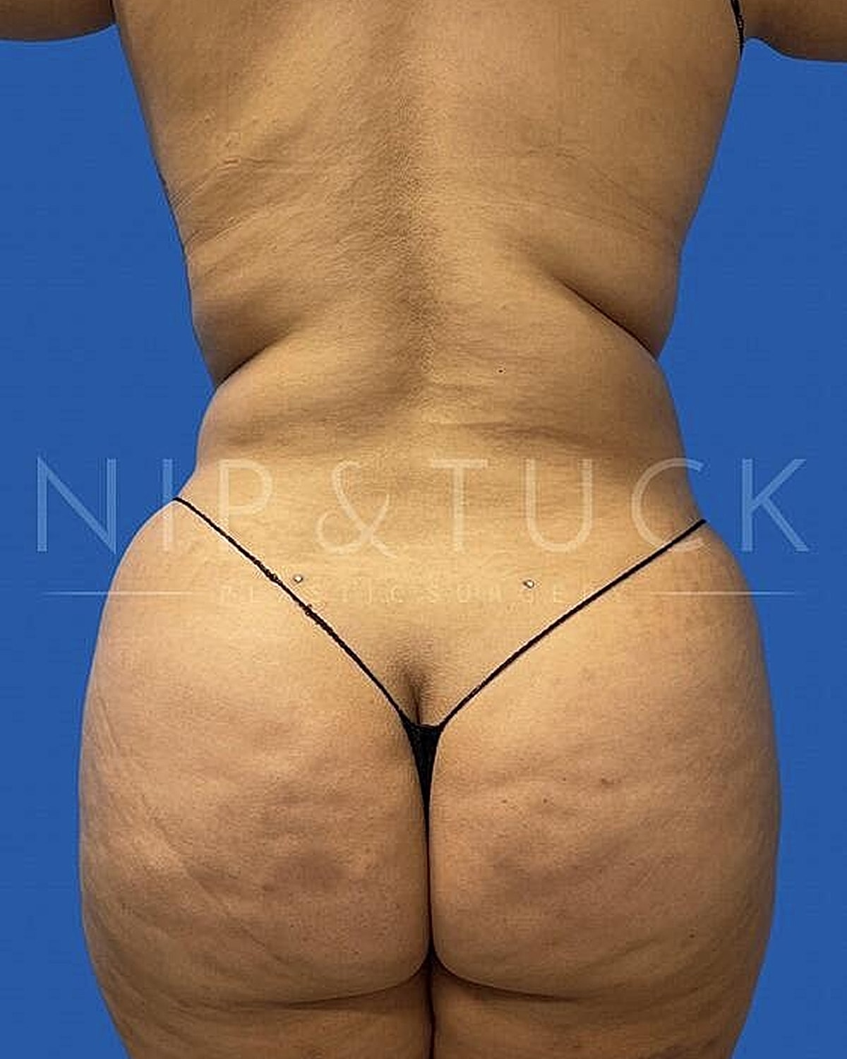 Liposuction Before & After