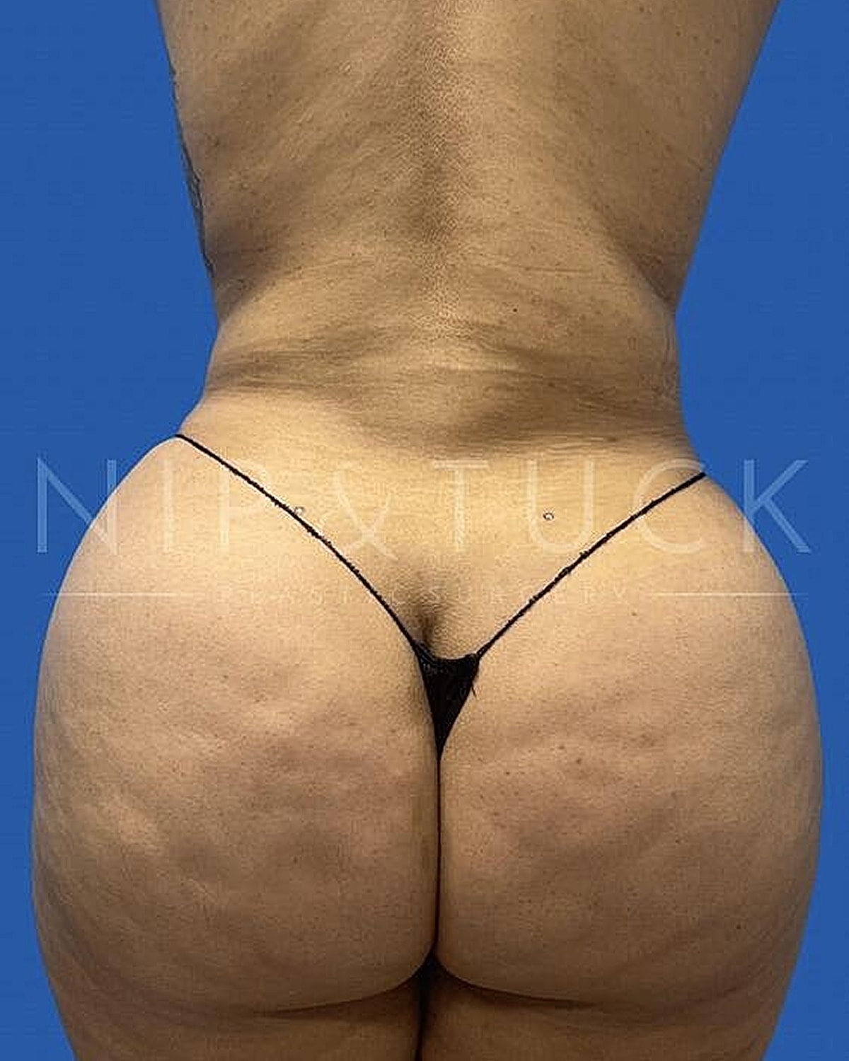 Liposuction Before & After