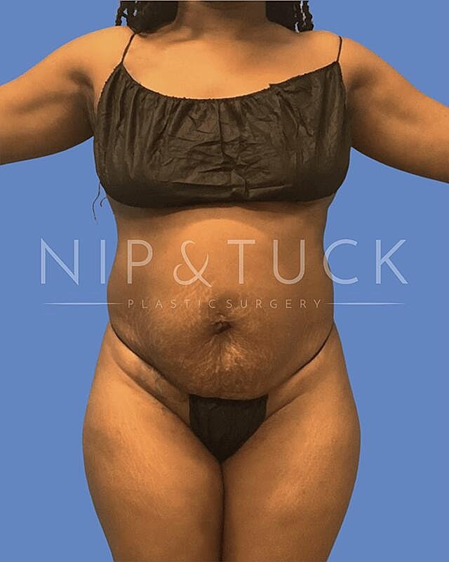 Liposuction Before & After