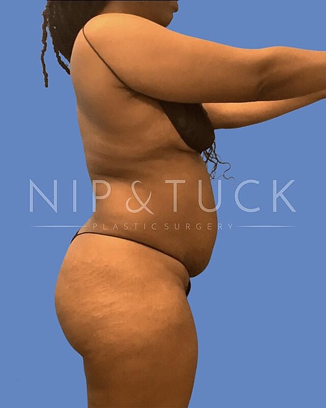 Liposuction Before & After