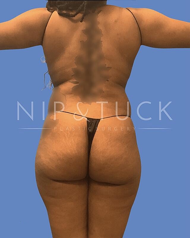 Liposuction Before & After