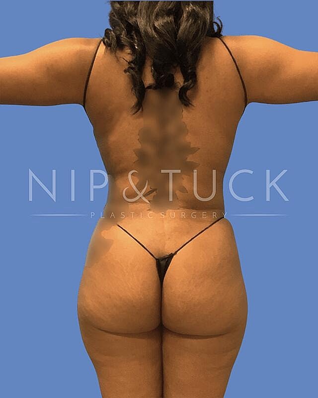 Liposuction Before & After