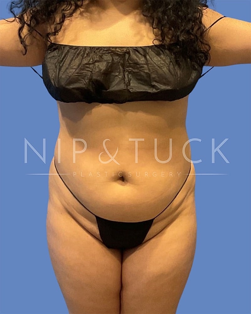 Liposuction Before & After