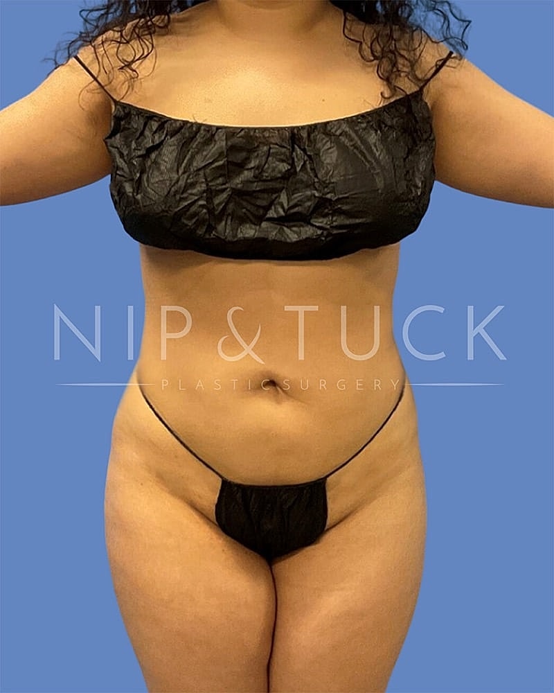Liposuction Before & After