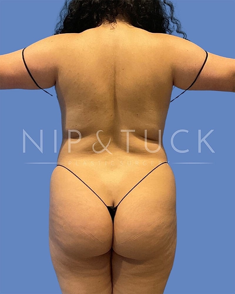 Liposuction Before & After