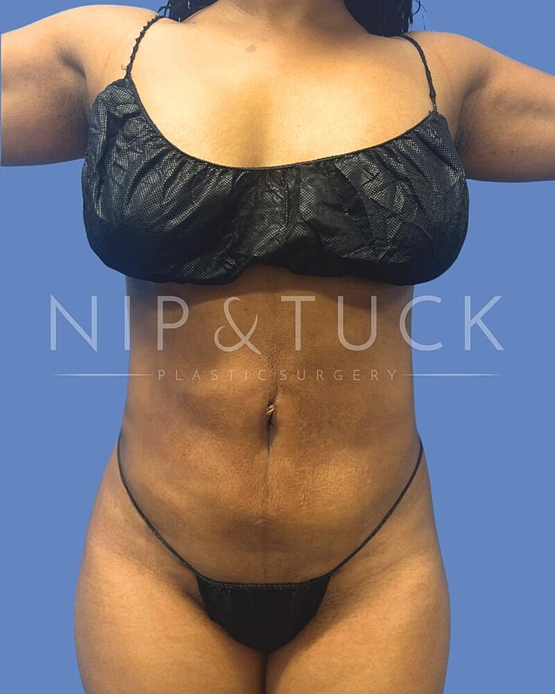 Liposuction Before & After