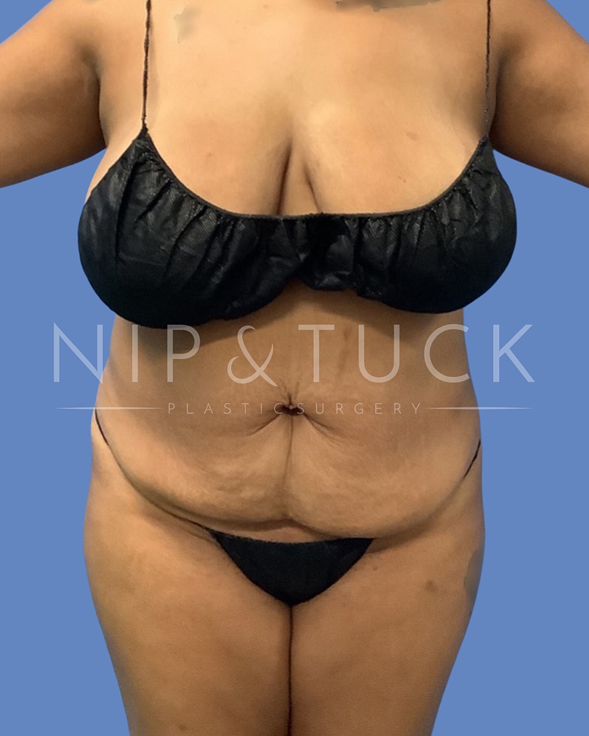 Liposuction Before & After