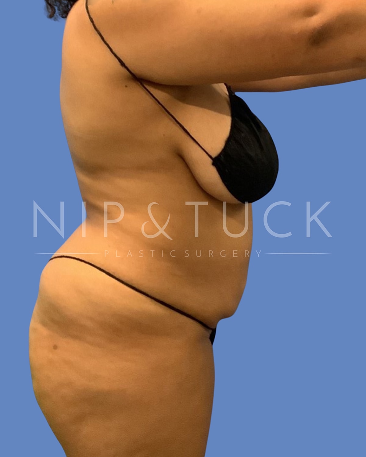 Liposuction Before & After