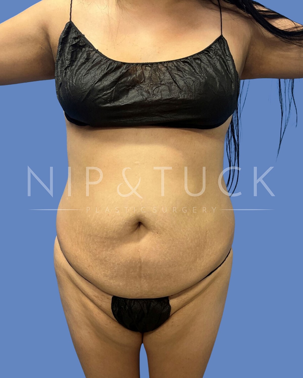 Liposuction Before & After