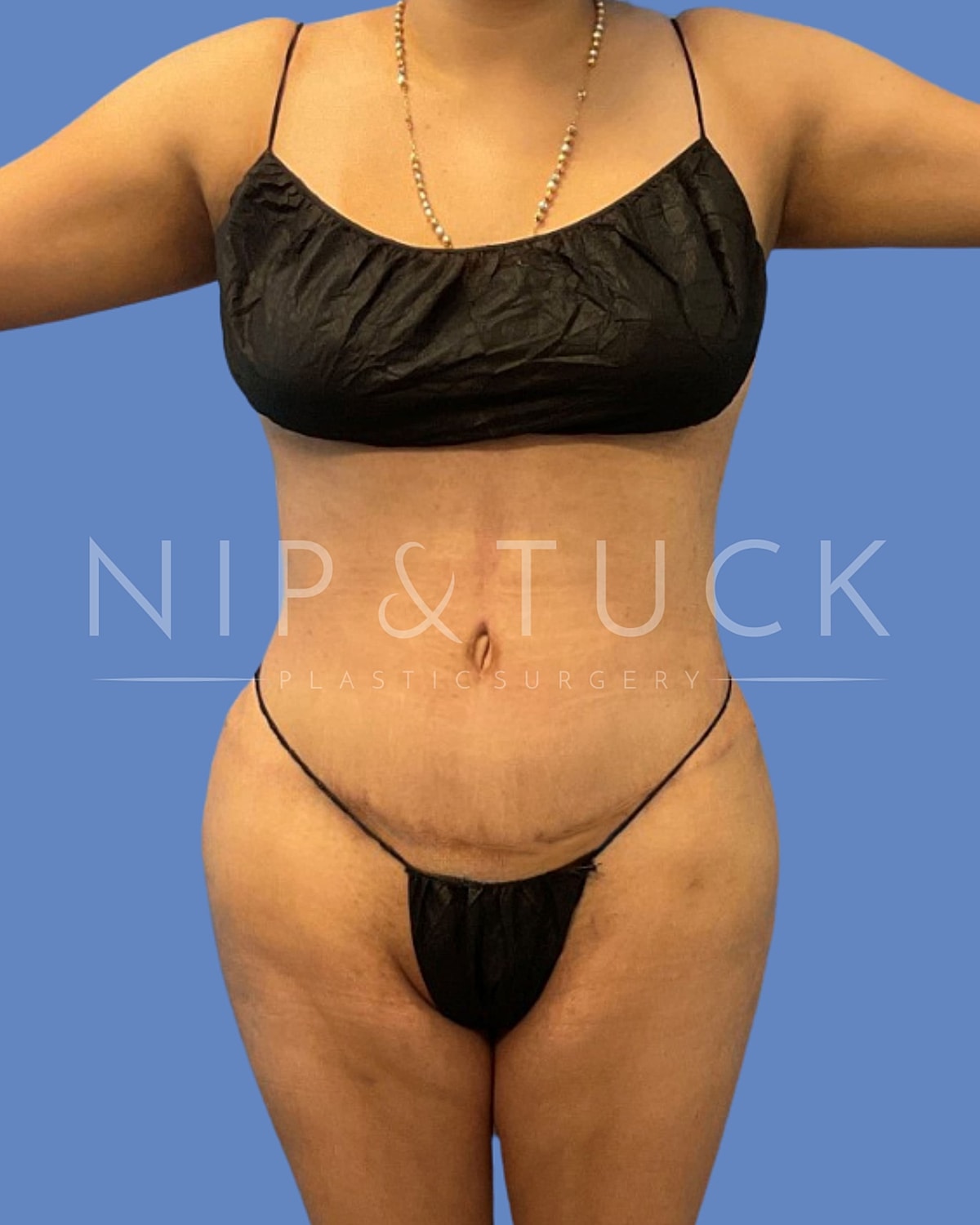 Liposuction Before & After