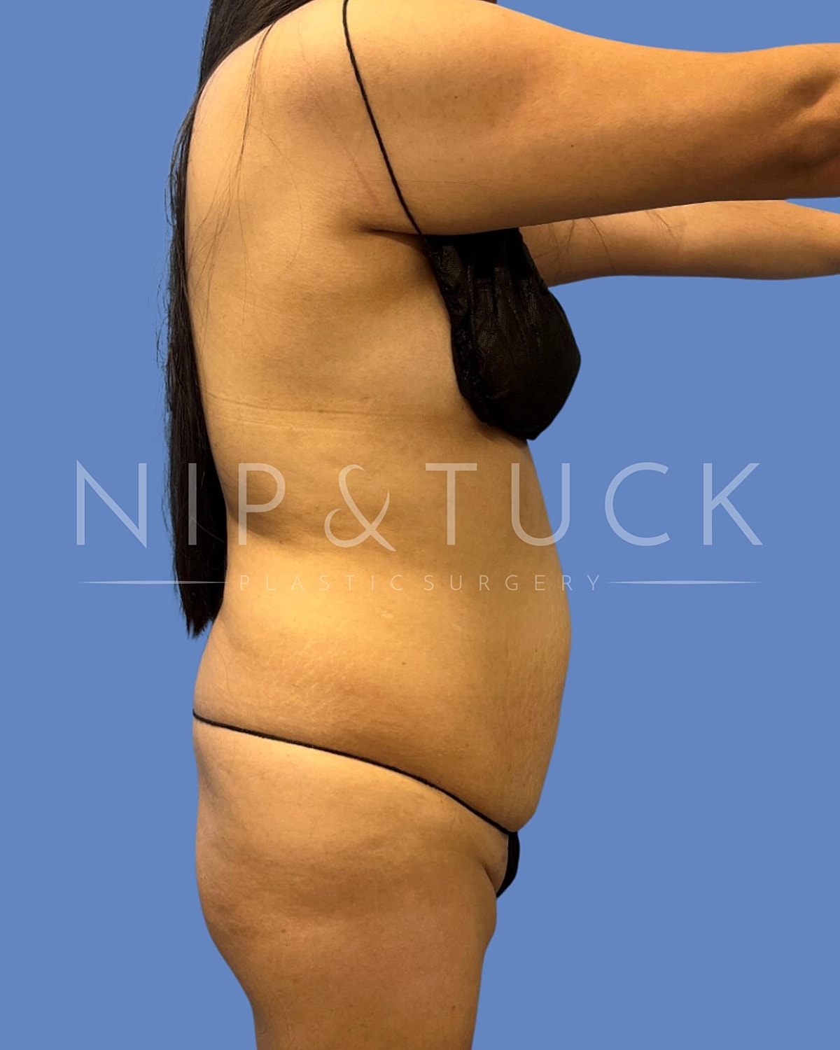 Liposuction Before & After