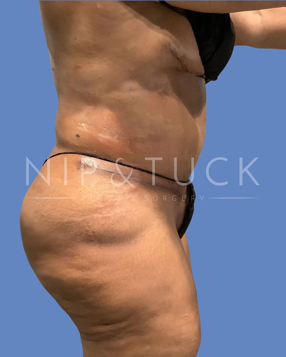 Liposuction Before & After