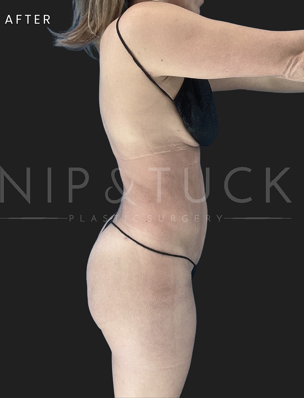 Liposuction Before & After