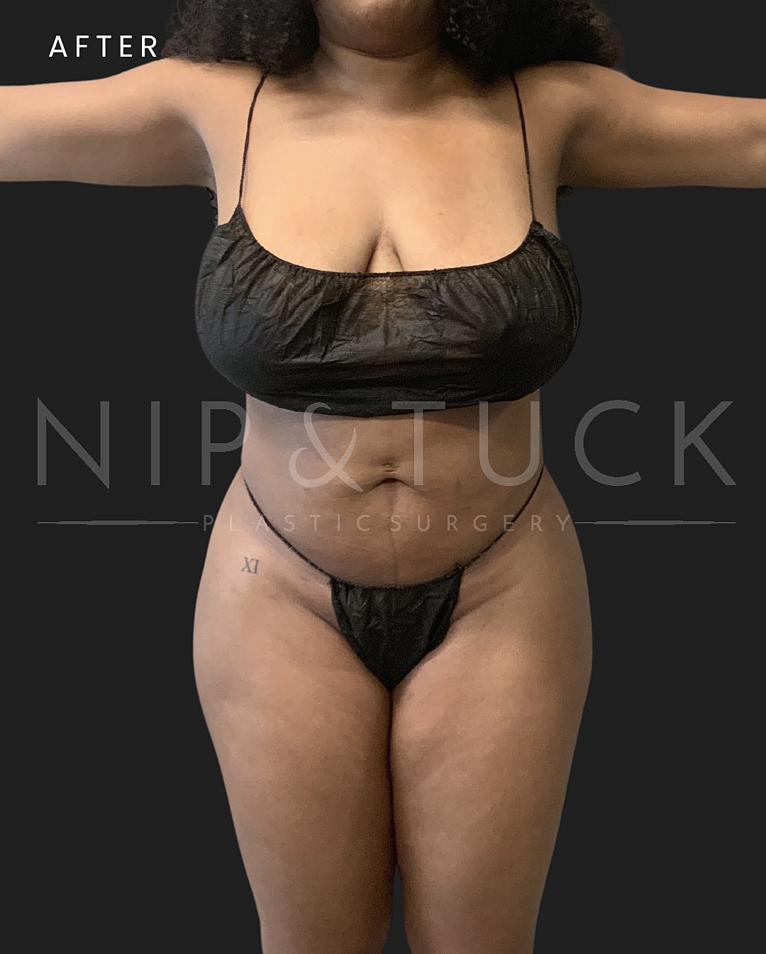 Liposuction Before & After