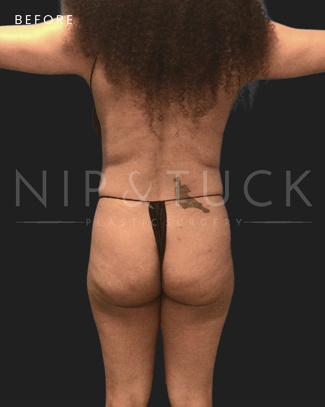 Liposuction Before & After