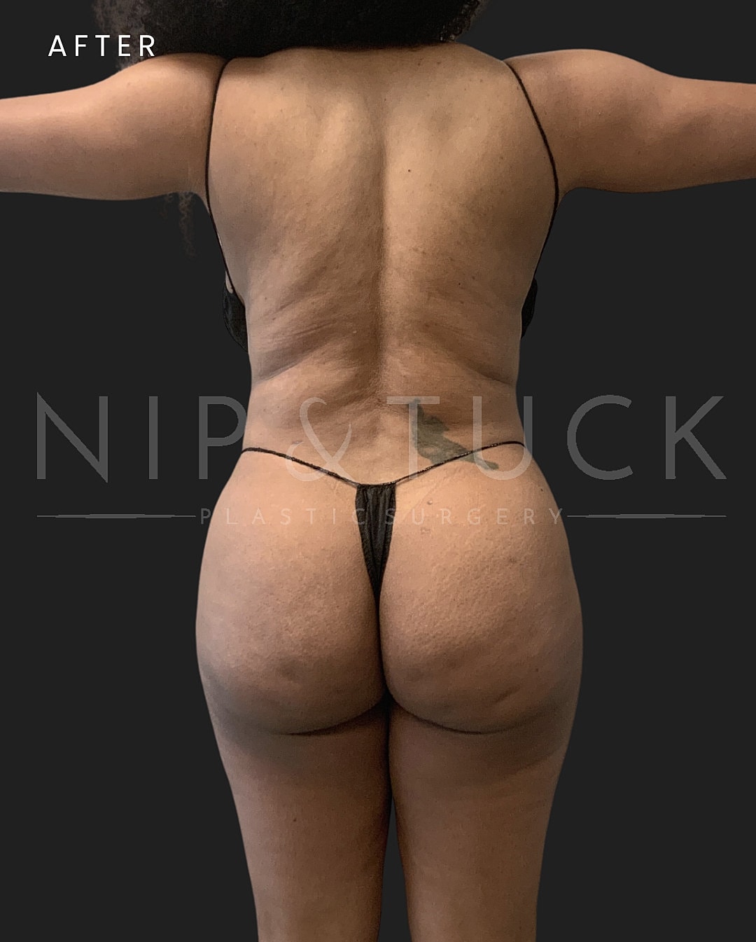 Liposuction Before & After
