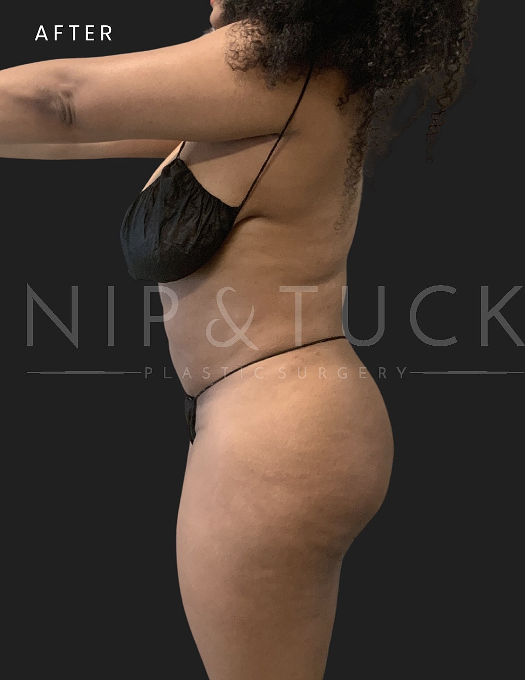 Liposuction Before & After