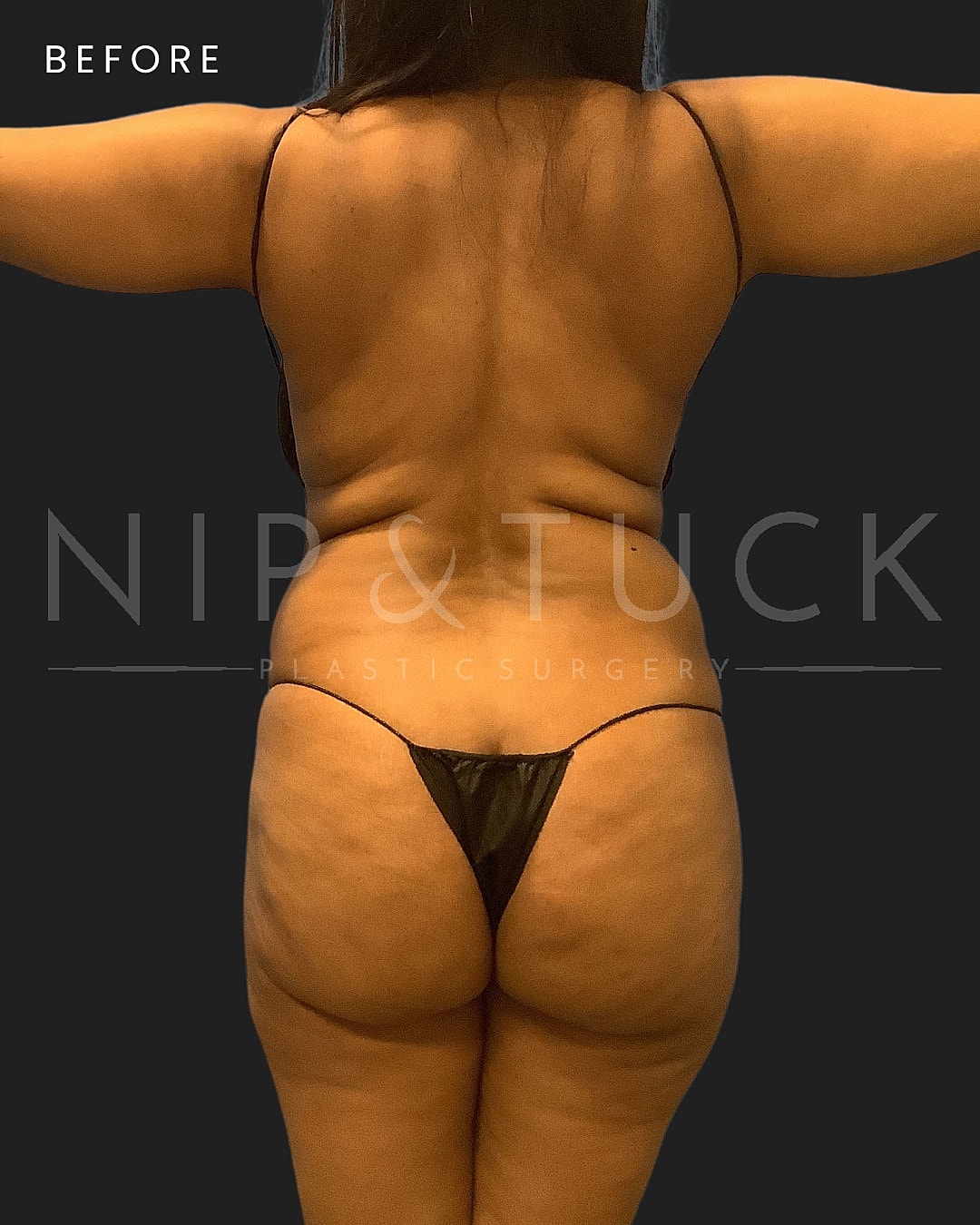 Liposuction Before & After