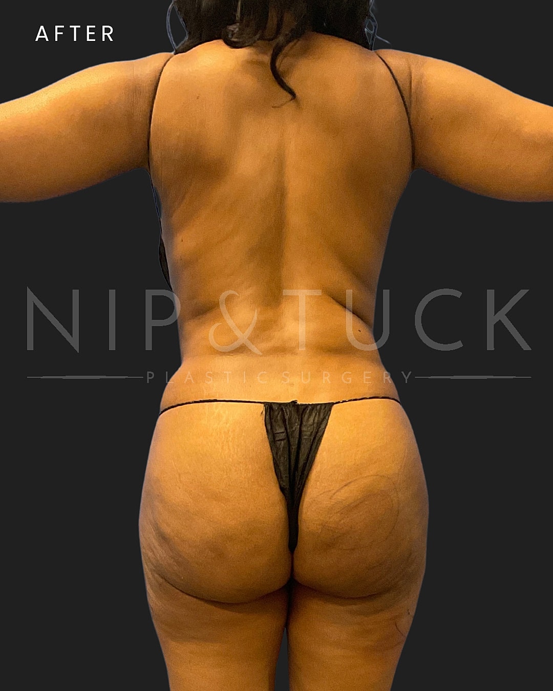 Liposuction Before & After