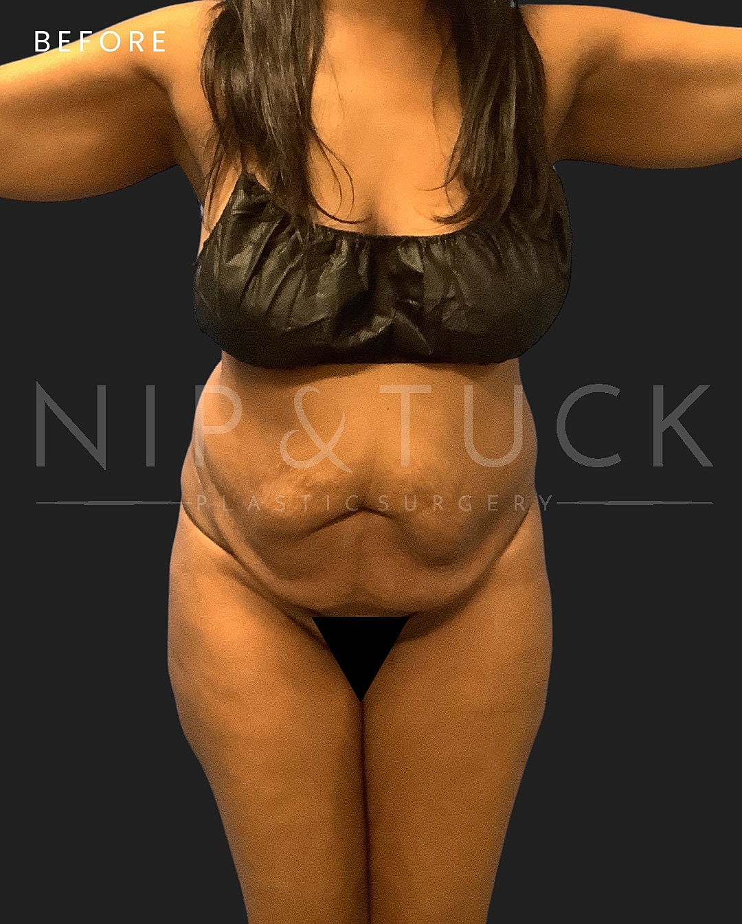 Liposuction Before & After