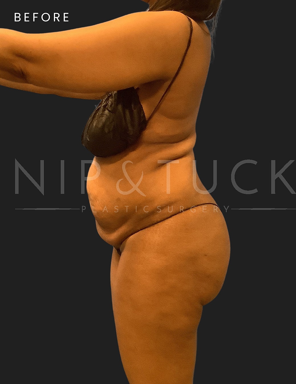 Liposuction Before & After