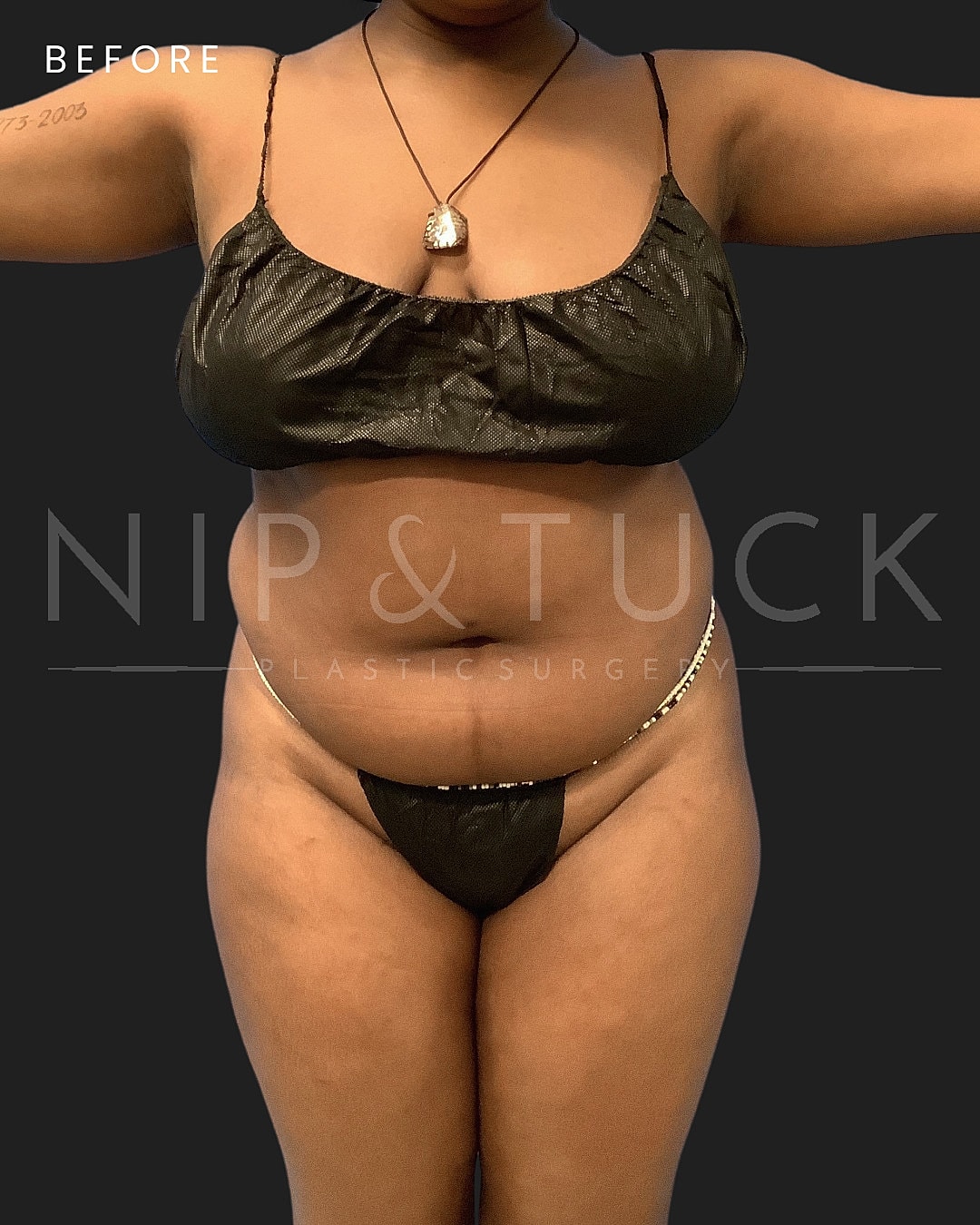 Liposuction Before & After