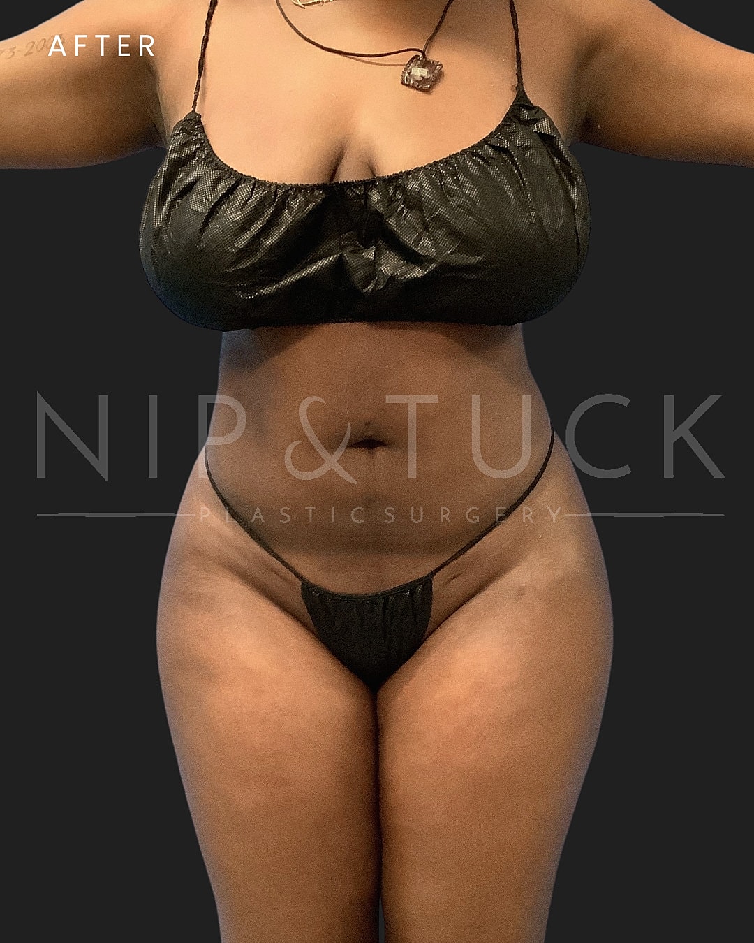Liposuction Before & After