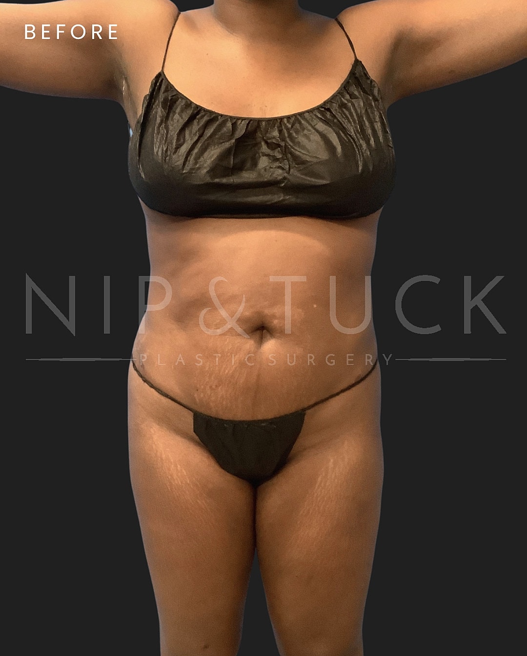 Liposuction Before & After
