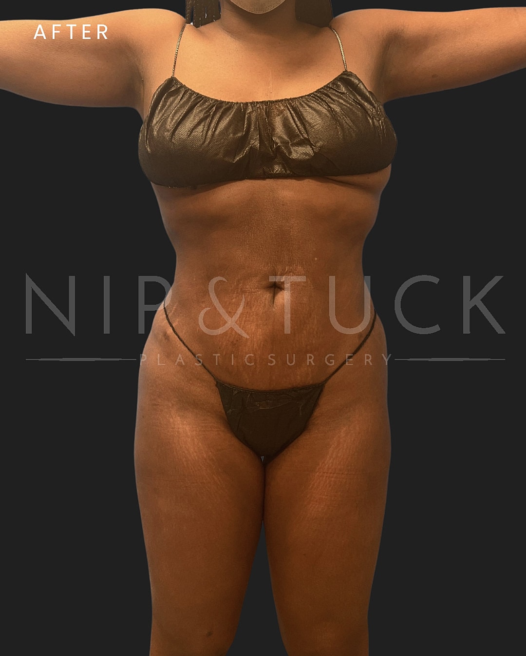 Liposuction Before & After