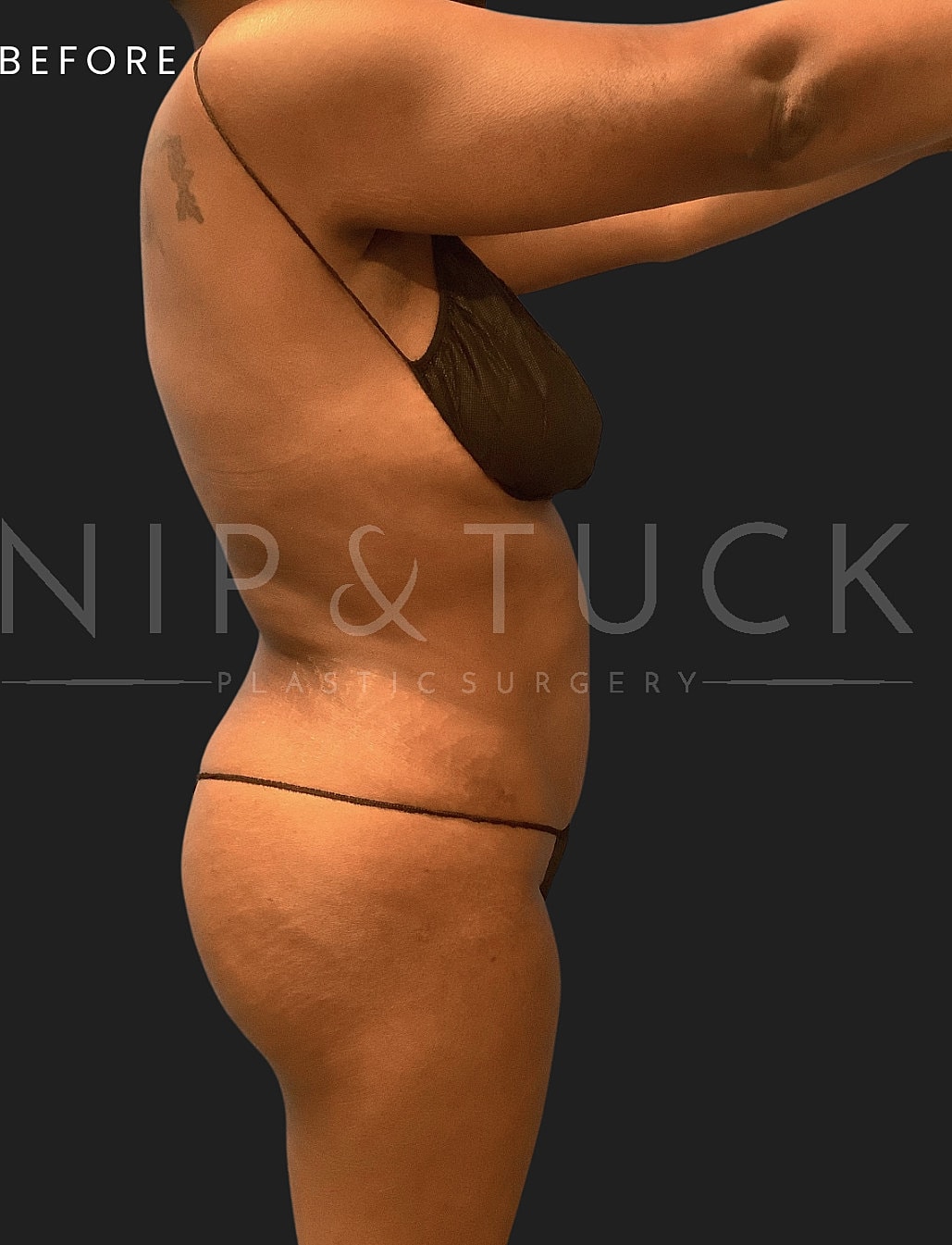 Liposuction Before & After