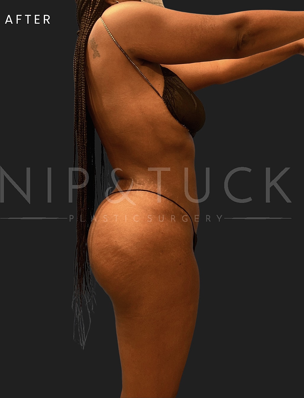 Liposuction Before & After