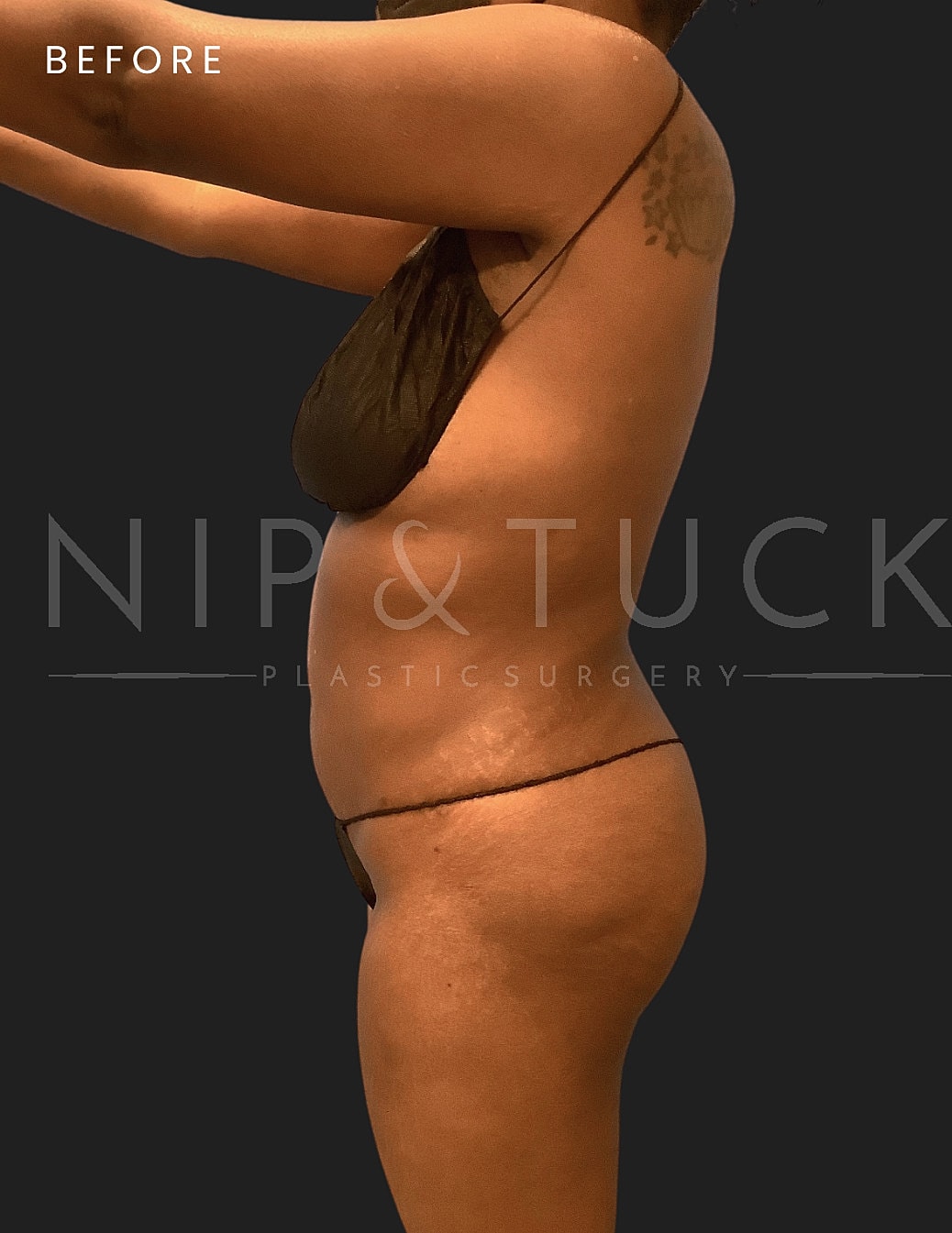 Liposuction Before & After