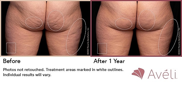 Before and after body treatment comparison image.