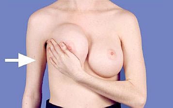 Breast self-examination technique demonstration.